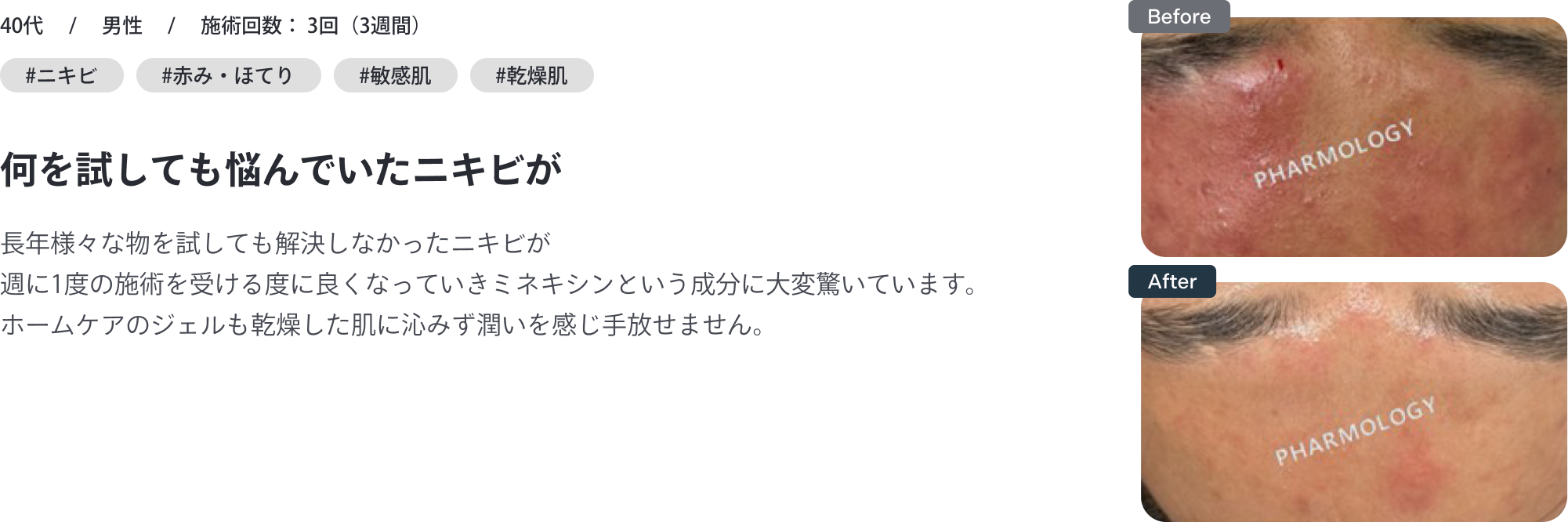 40代・男性｜何を試しても悩んでいたニキビが