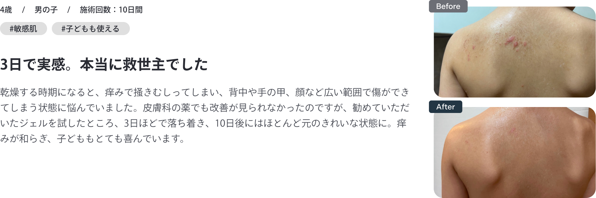 4歳・男の子・敏感肌｜3日で実感。本当に救世主でした